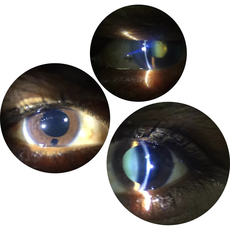Super clear anterior images from Remdio's Portable Digital Slit Lamp